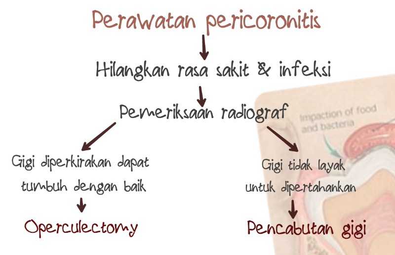 bagan-pericoronitis.jpeg image