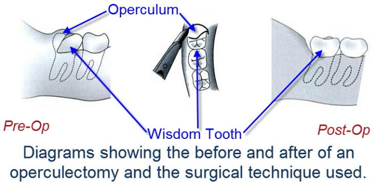 wpid-operculectomy_technique_-_cold_steel-735x357.jpg image